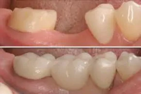 Dental Bridges