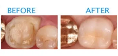 Dental Crowns