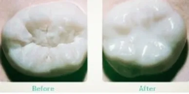 Dental Sealants